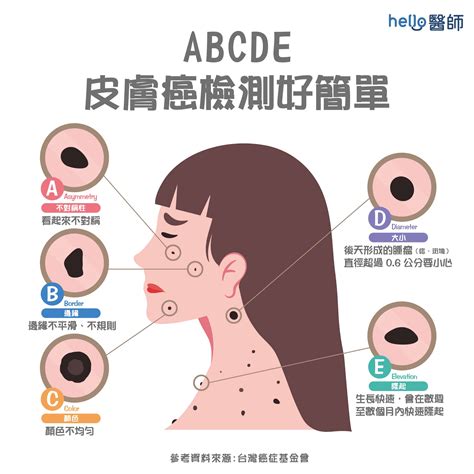 臉部黑痣|痣變大、痣多或長毛會變皮膚癌？認識痣的形成與原因